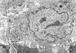 M, 1y. | histiocytosis X (eosinophilic granuloma) … Langerhans cell